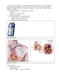 Stimularea electrică intracavitară pacing, defibrilare, resuscitare și telemetrie intracavitară - Pagina 4