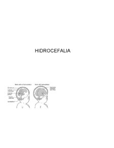 Hidrocefalie - Pagina 1