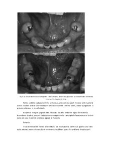 Reabilitarea orală cu ajutorul protezelor parțiale amovibile în cazul edentățiilor întinse - Pagina 5