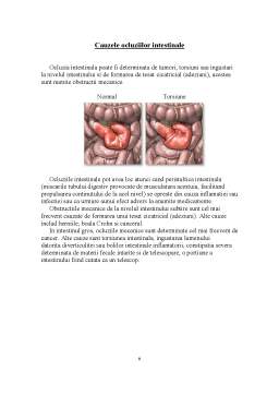 Referat - Ocluzia intestinală