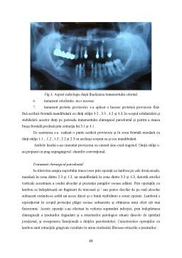 Licență - Afecțiunile parodontale la pacienții cu boli cronice