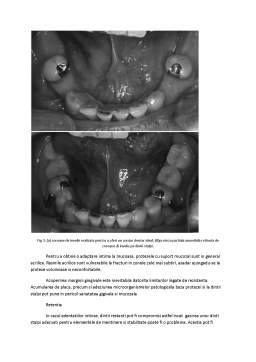 Referat - Reabilitarea orală cu ajutorul protezelor parțiale amovibile în cazul edentățiilor întinse