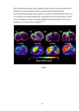 Licență - Elastografia impulsională - Comparație între sonda M și XL folosite în evaluarea fibrozei hepatice
