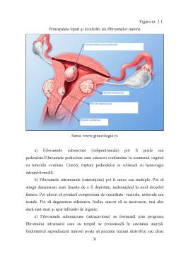 Licență - Nursingul pacienței cu fibrom uterin