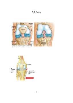 Licență - Îngrijirile pacientului cu instabilitate cronica de genunchi