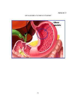 Licență - Ulcerul gastric