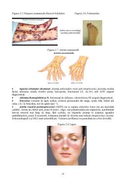 Reumatismul articular acut (RAA) | prajituri-cluj.ro