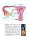 Avortul Hormonal și Chimic